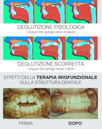 miof2