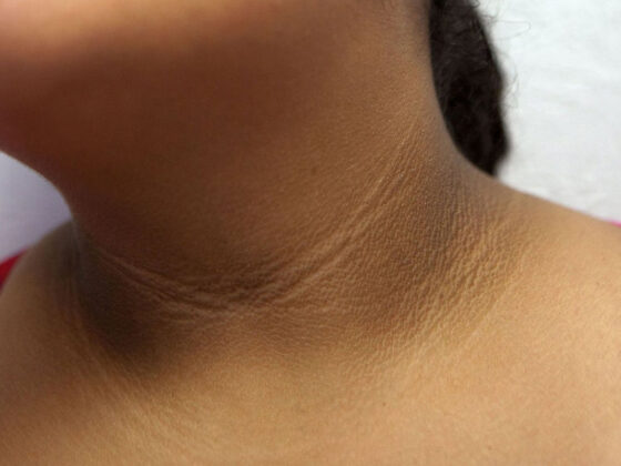 acanthosis nigricans